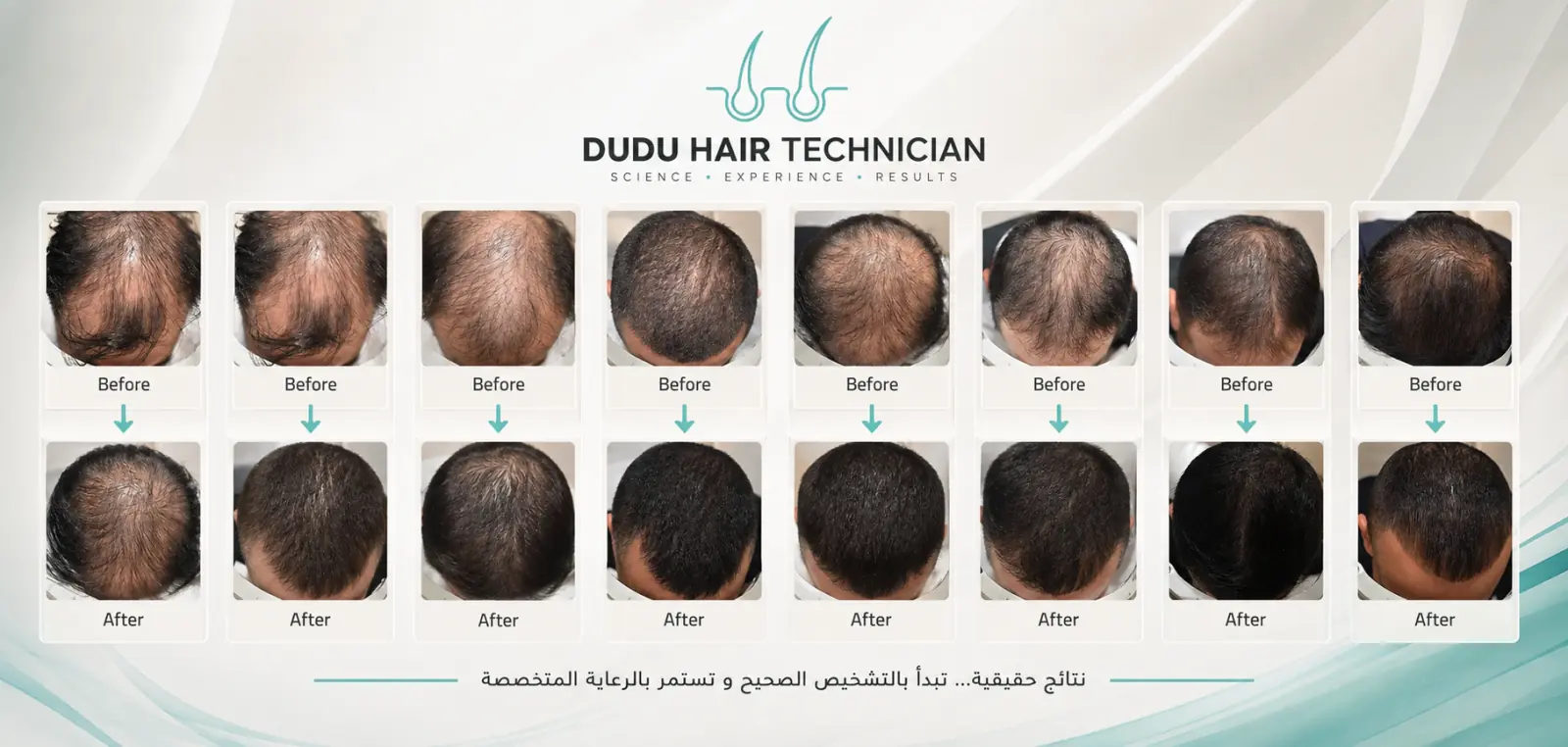 مجموعة نتائج قبل وبعد من حالات تقنية دودو مصاروة
