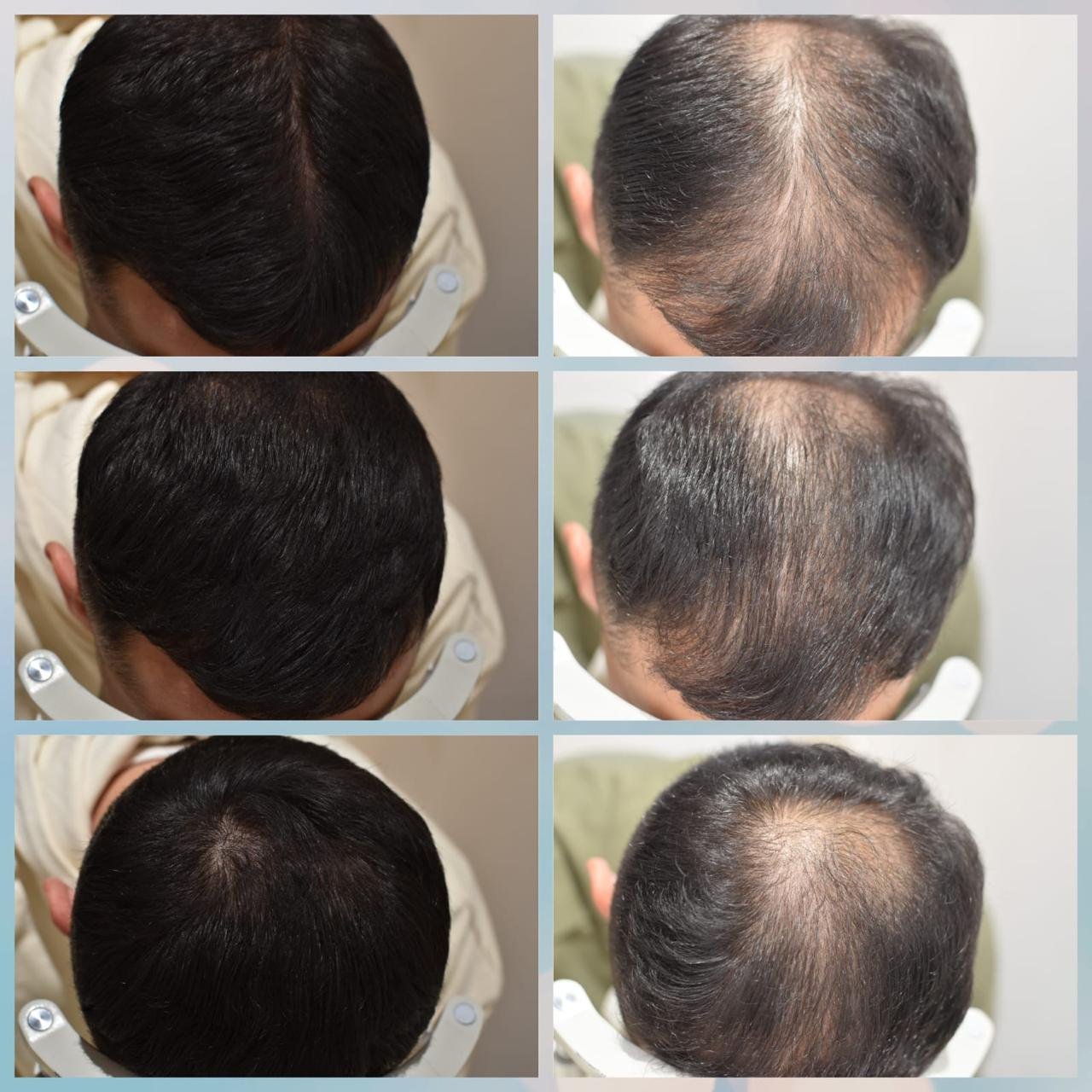 Dudu Masarwa’s Technique for Treating Hair Loss and Genetic Baldness: A Revolutionary Alternative to Hair Transplantation.