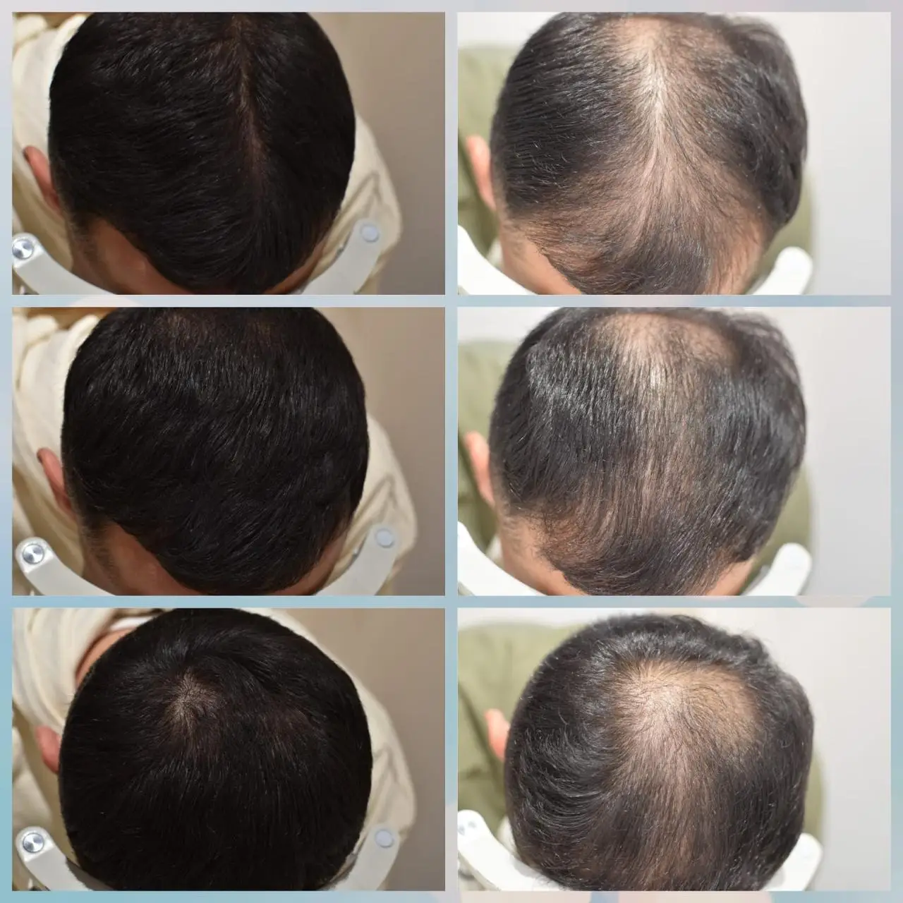 ابتكار دودو مصاروة في علاج الصلع الوراثي: الحل العلمي الذي يغنيك عن زراعة الشعر